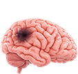 Ictus