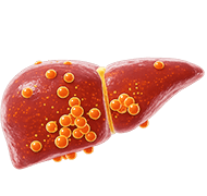Cirrosis
