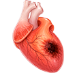 Infarto